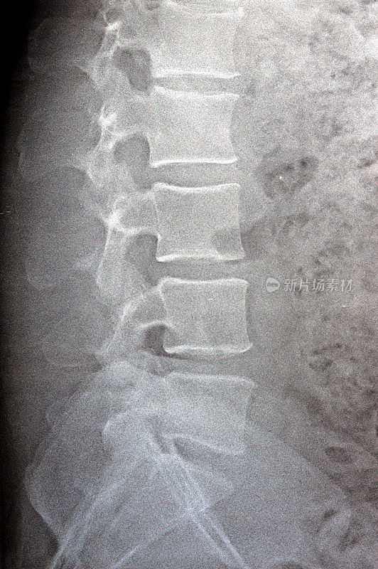 腰骶椎X线平片显示腰椎挺直，轻度脊柱侧凸畸形，腰椎突变，双侧骶髂炎，L4-L5, L5- S1椎间盘间隙轻度狭窄